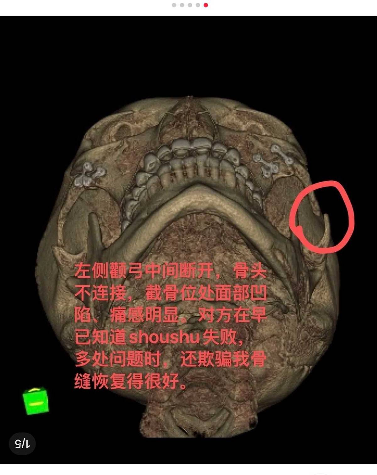 上海华美再曝颧骨内推手术失败，消费者如何走出维权困境？