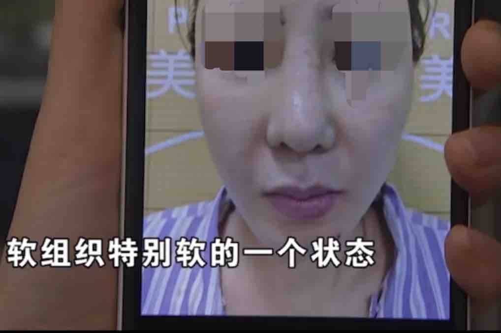 隆鼻毁容谁之过?女子爆杭州清锴医疗美容术后感染纠纷始末! 隆鼻毁容谁之过?女子爆杭州清锴医疗美容术后感染纠纷始末!