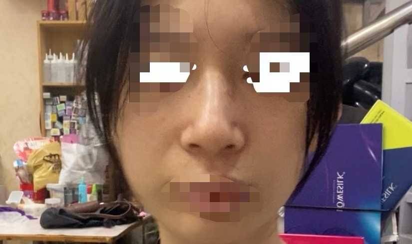 广州美莱医疗美容被指注射妆字号水光针,医美安全谁来守护? 广州美莱医疗美容被指注射妆字号水光针,医美安全谁来守护?