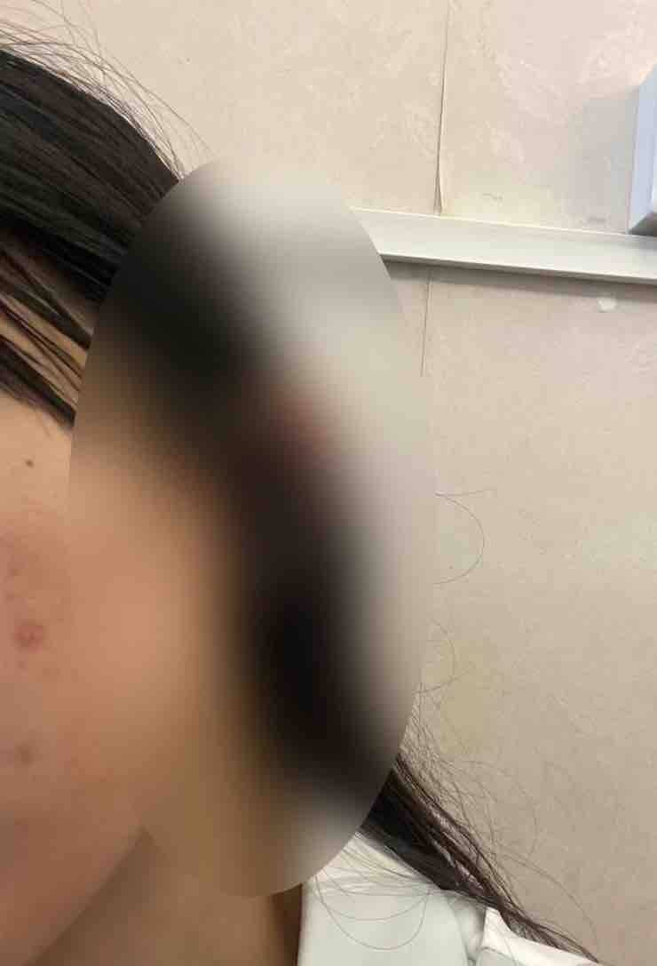 隆鼻后鼻孔一大一小，深圳阳光医美曾卷入“评级门”丑闻