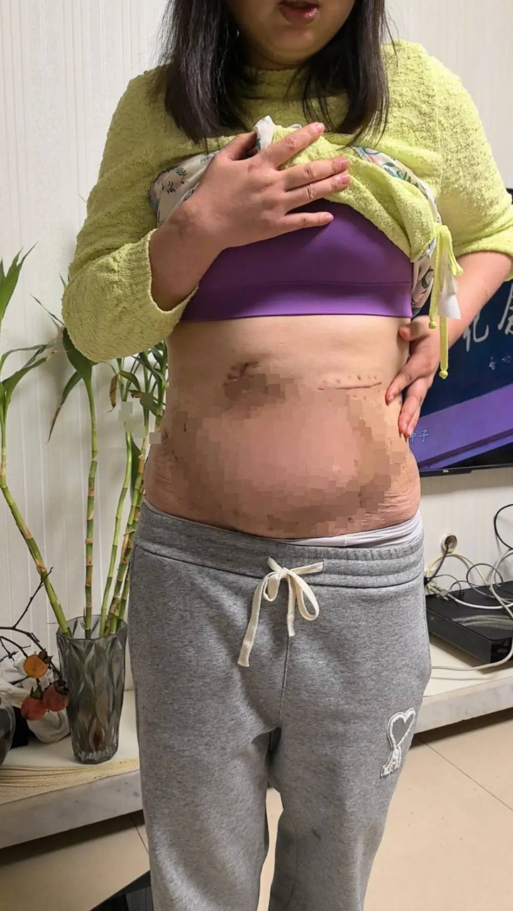 女子在泸州陈清整形医学美容门诊抽脂失败致肠穿孔等22病症! 女子在泸州陈清整形医学美容门诊抽脂失败致肠穿孔等22病症!