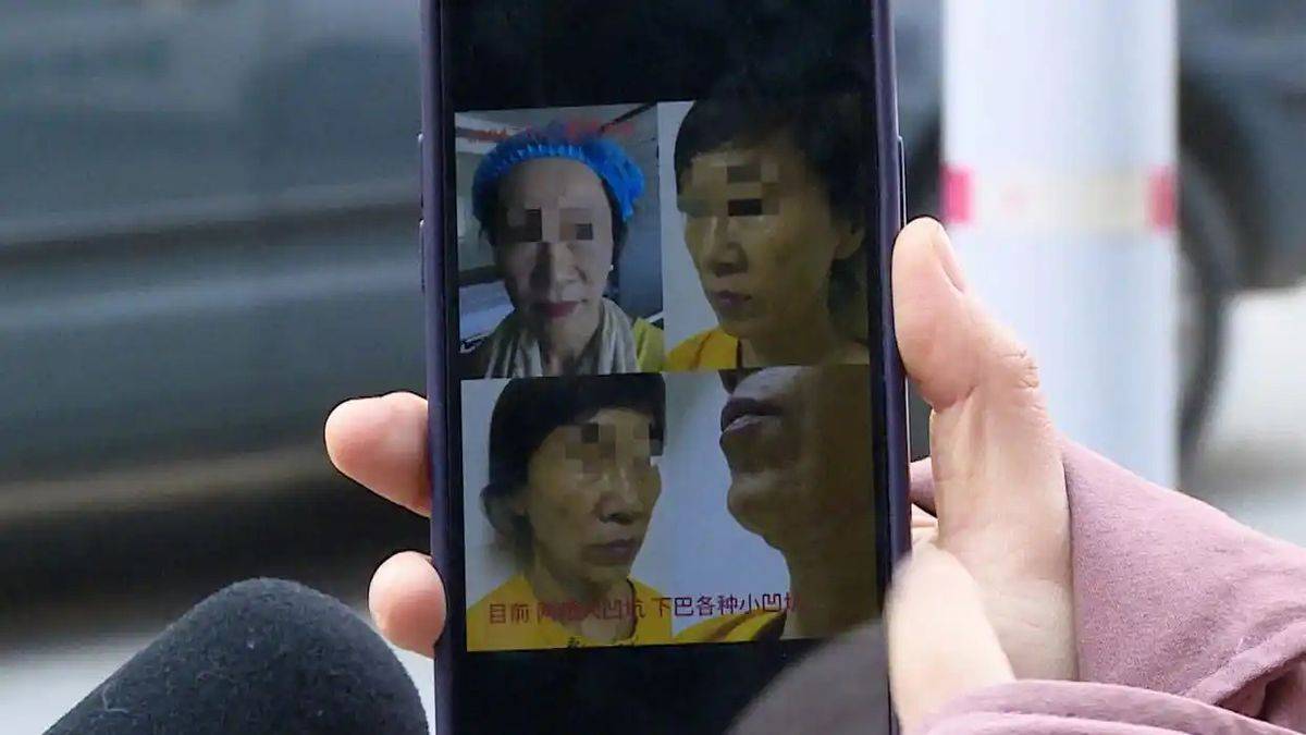 18万除皱针打出俩大坑，青岛花际医美跨区执业不是头一回！