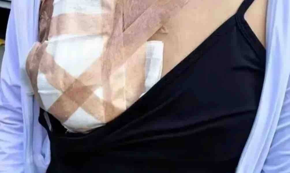 女子隆鼻后鼻子挛缩成“猪鼻”，长沙铂丽瑞思医疗美容“她吸毒”！