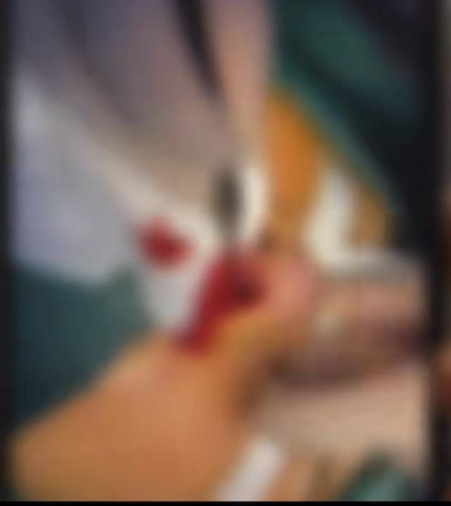 隆鼻毁容谁之过?女子爆杭州清锴医疗美容术后感染纠纷始末! 隆鼻毁容谁之过?女子爆杭州清锴医疗美容术后感染纠纷始末!