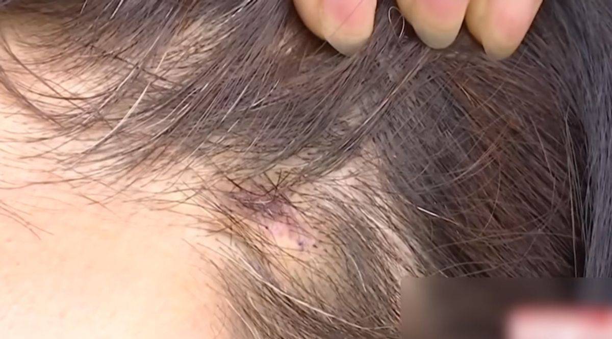 拉皮后眉毛不能动，宁波鄞州童颜医疗美容黑历史洗白难！