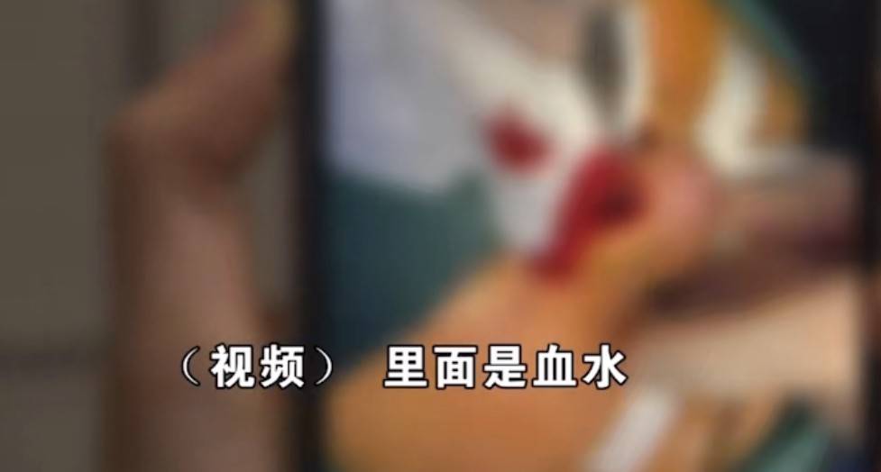 隆鼻毁容谁之过?女子爆杭州清锴医疗美容术后感染纠纷始末! 隆鼻毁容谁之过?女子爆杭州清锴医疗美容术后感染纠纷始末!