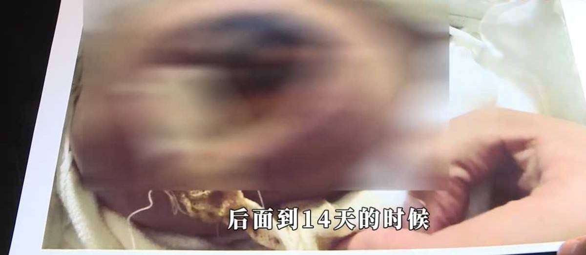 女子称在湖南雅美医美隆胸后胸部像石头,导致两任男友均分手 女子称在湖南雅美医美隆胸后胸部像石头,导致两任男友均分手