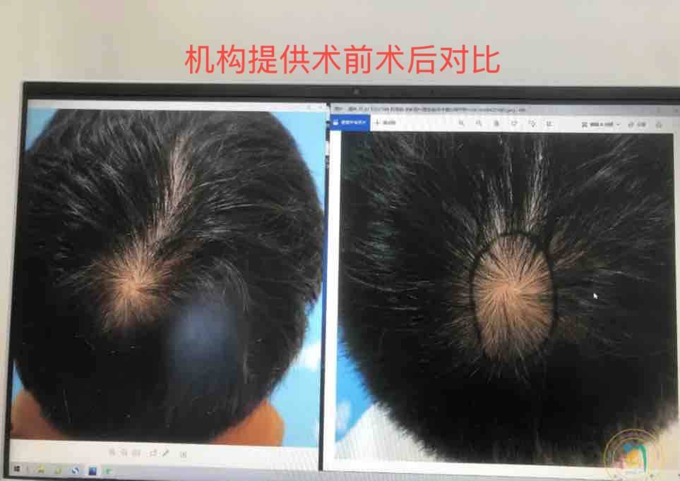 植发后不如不植？新京报曝雍禾医疗存活率五大保障履约难