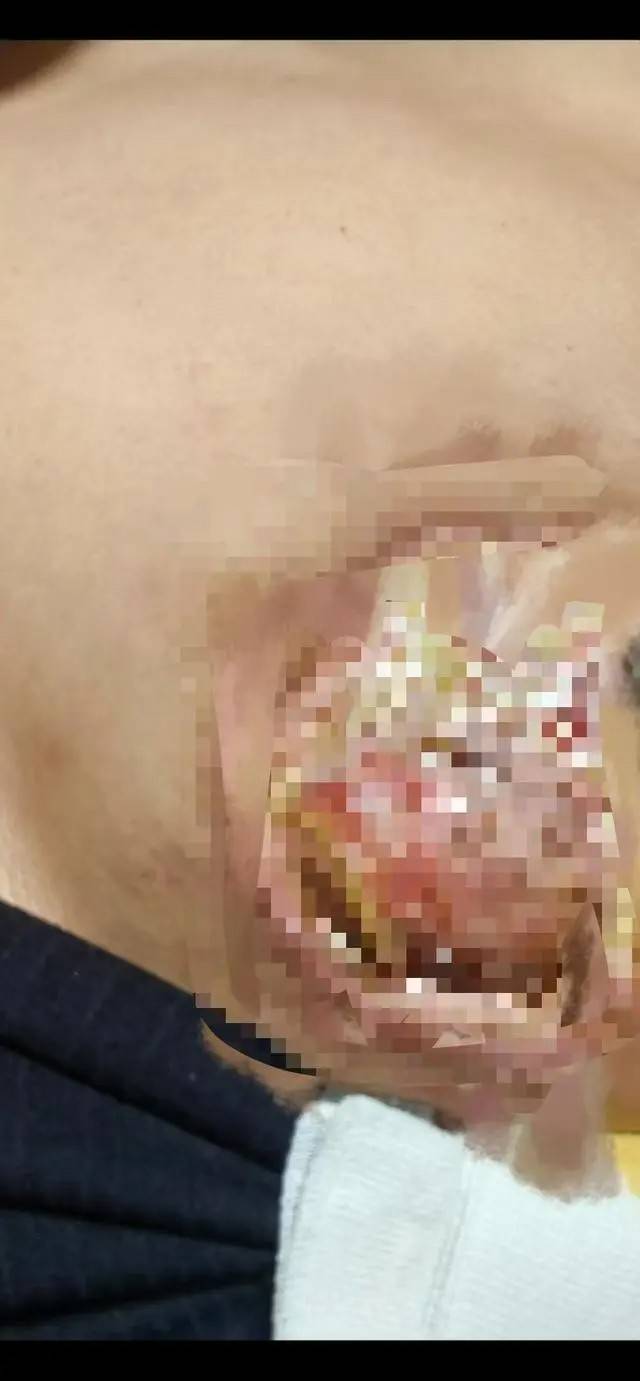逆天的长沙铂丽瑞思医美!销售三无药品后又把消费者胸做烂了! 逆天的长沙铂丽瑞思医美!销售三无药品后又把消费者胸做烂了!