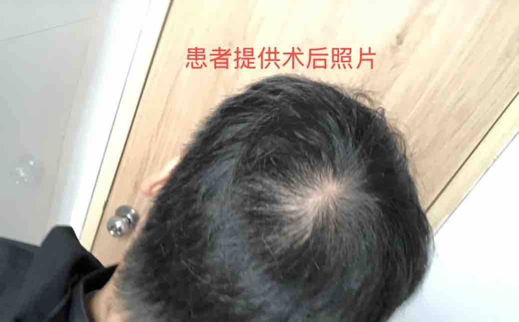 植发后不如不植？新京报曝雍禾医疗存活率五大保障履约难