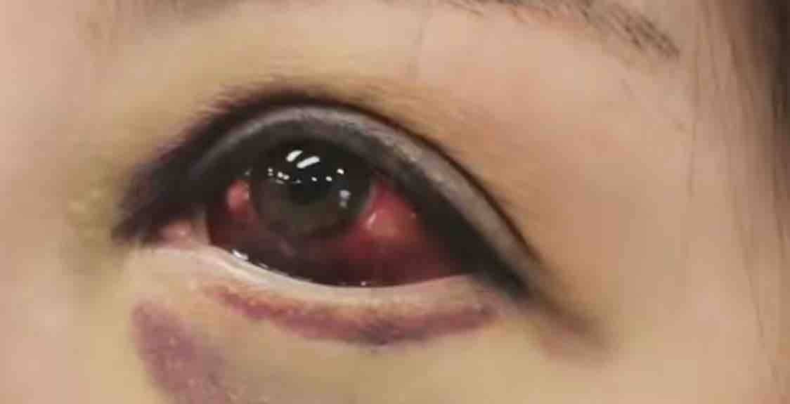 术后眼球充血，医疗鉴定存疑，西安艺星医疗美容再陷维权纷争