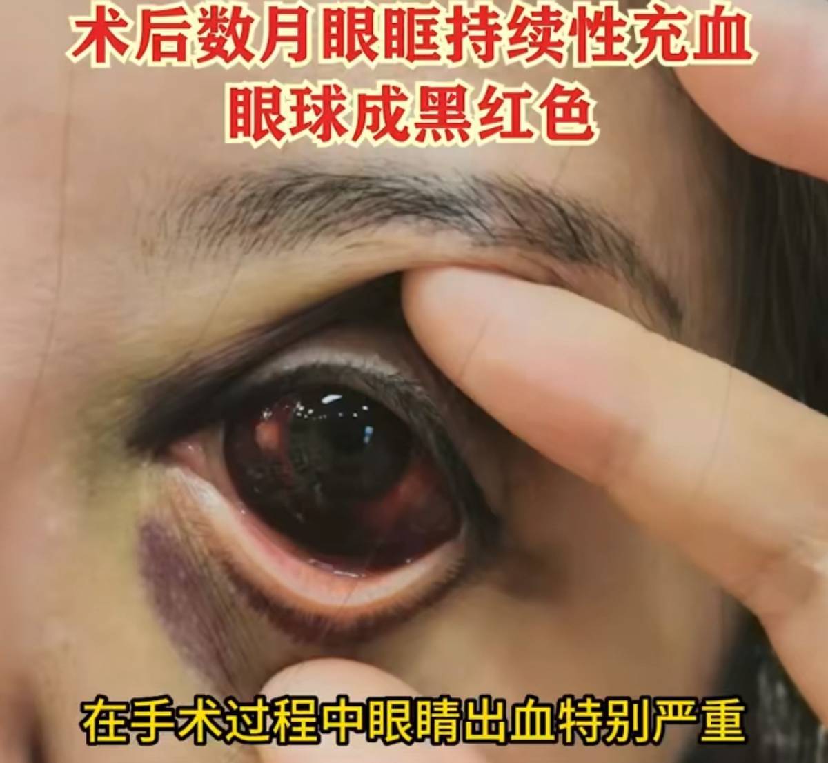 术后眼球充血，医疗鉴定存疑，西安艺星医疗美容再陷维权纷争