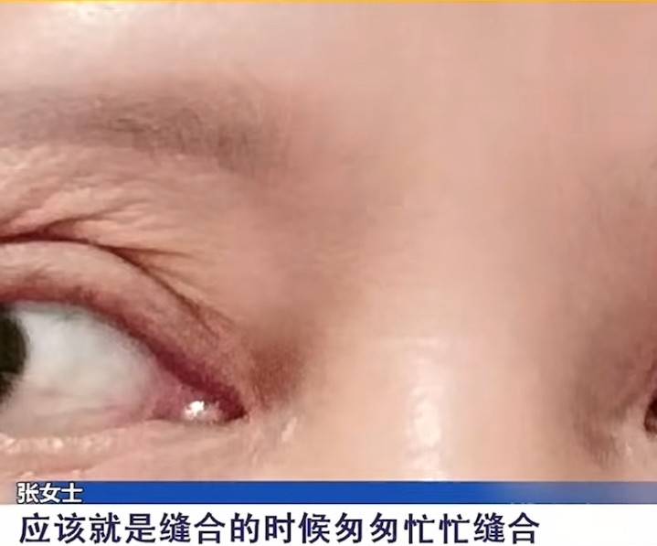 割个双眼皮也能“大出血”,南京星海荟医美维权退款难! 割个双眼皮也能“大出血”,南京星海荟医美维权退款难!