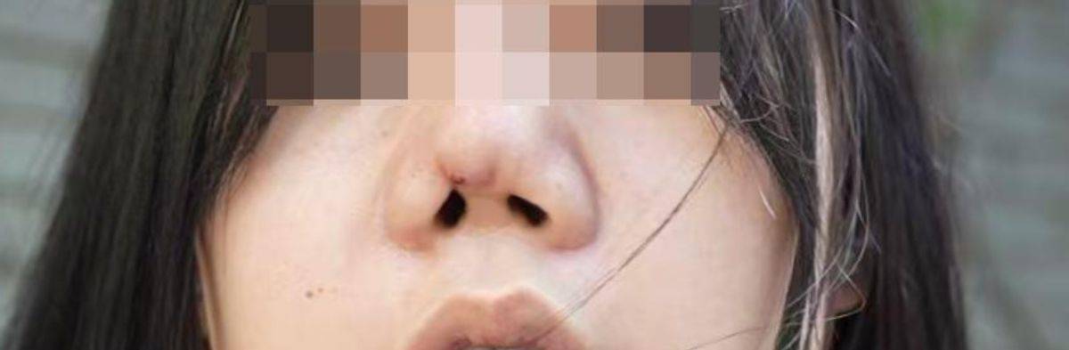 女子隆鼻后鼻子挛缩成“猪鼻”，长沙铂丽瑞思医疗美容“她吸毒”！