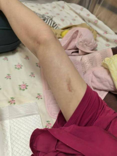 女子在泸州陈清整形医学美容门诊抽脂失败致肠穿孔等22病症! 女子在泸州陈清整形医学美容门诊抽脂失败致肠穿孔等22病症!