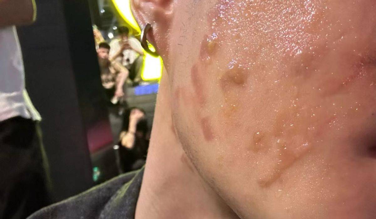 男模毁容维权,渠道医院上海瑰丽医疗美容烫伤消费者整张脸! 男模毁容维权,渠道医院上海瑰丽医疗美容烫伤消费者整张脸!